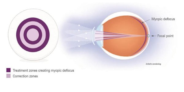 Diagrama de control de miopía: zonas de tratamiento que generan desenfoque miópico (myopic defocus) y zonas de corrección